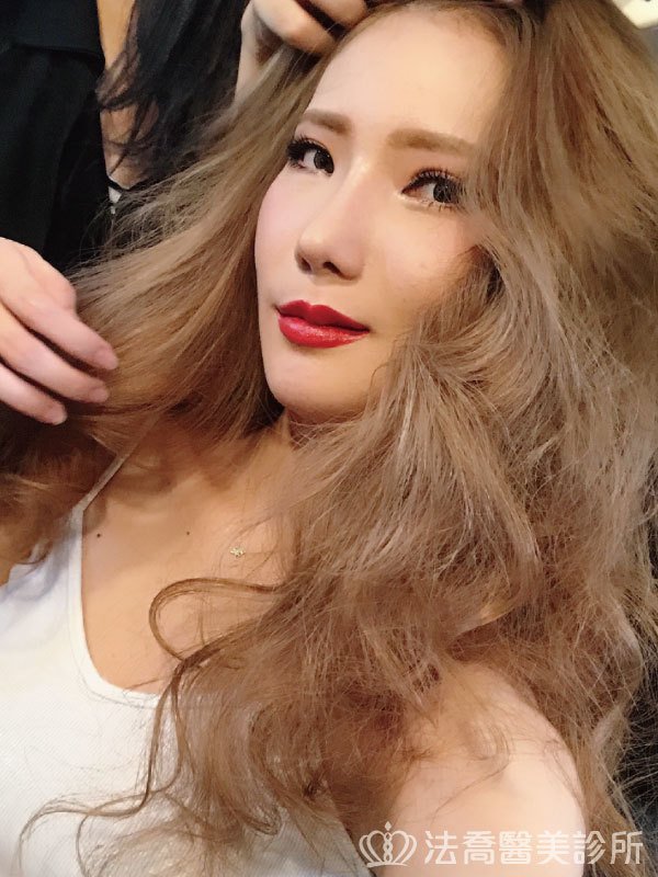 自體肋骨隆鼻
