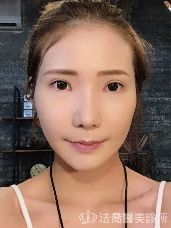 自體肋骨隆鼻