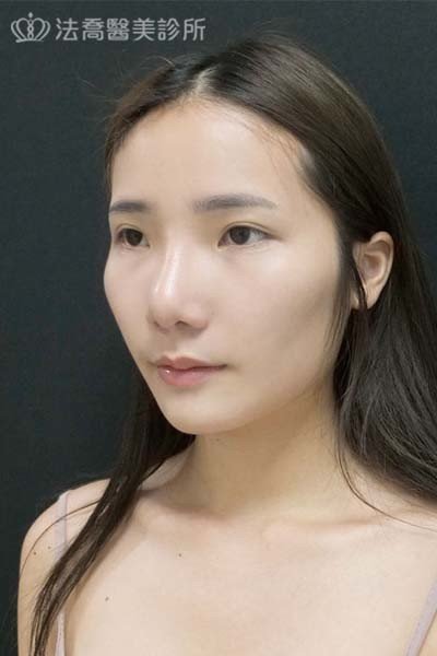 自體肋骨隆鼻