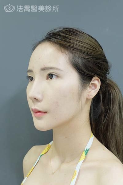 自體肋骨隆鼻