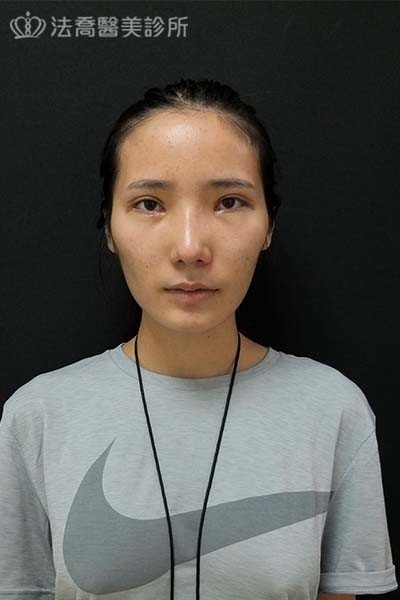 自體肋骨隆鼻