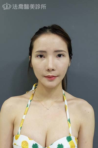 自體肋骨隆鼻