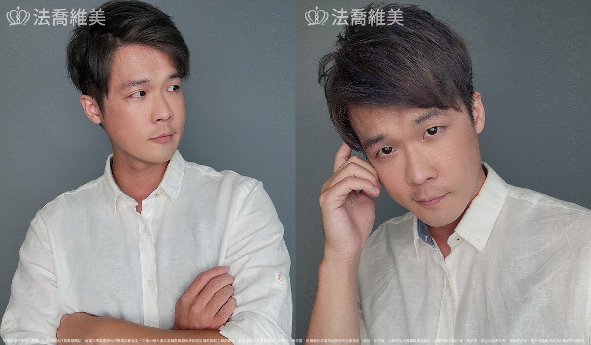 自體脂肪豐蘋果肌 / 術後1個月