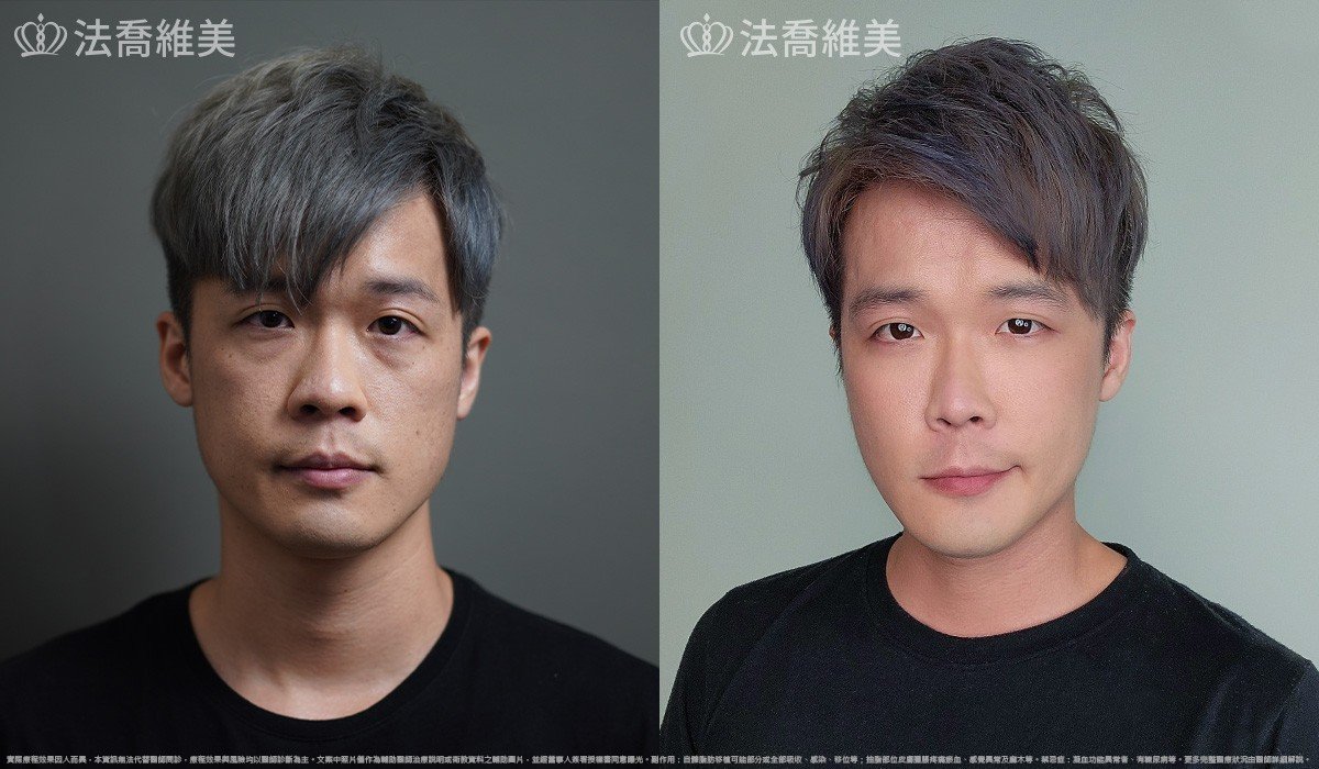 自體脂肪豐蘋果肌 / 術前與術後1個月