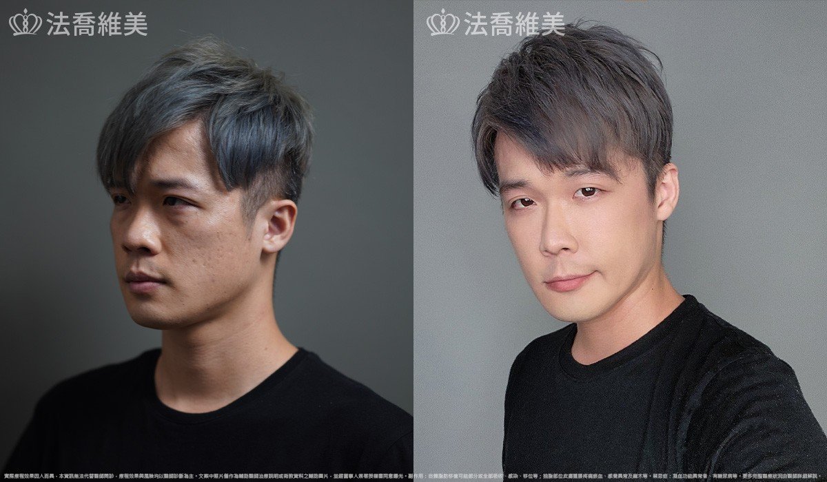 自體脂肪豐蘋果肌 / 術前與術後1個月