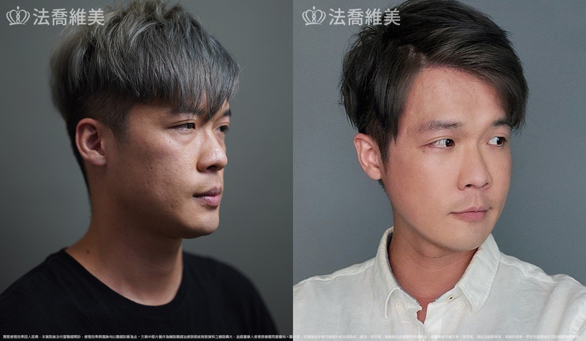 自體脂肪豐蘋果肌 / 術前與術後1個月