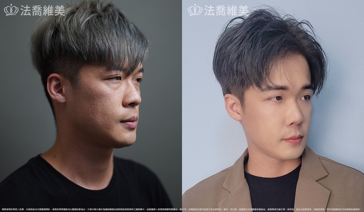 自體脂肪豐蘋果肌 / 術前與術後3個月