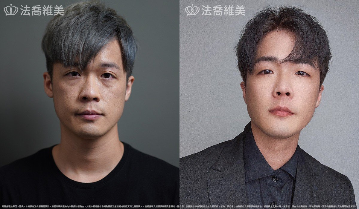 自體脂肪豐蘋果肌 / 術前與術後3個月