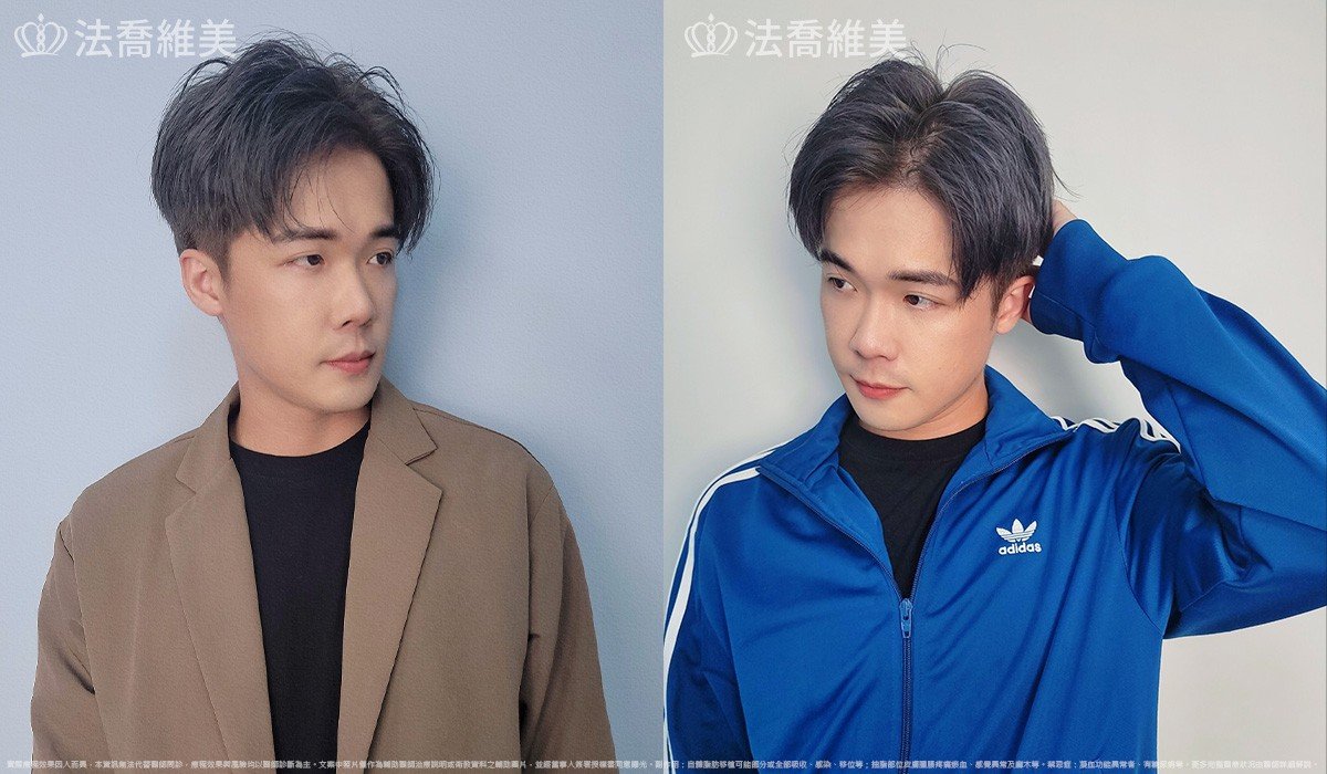 自體脂肪豐蘋果肌 / 術後3個月