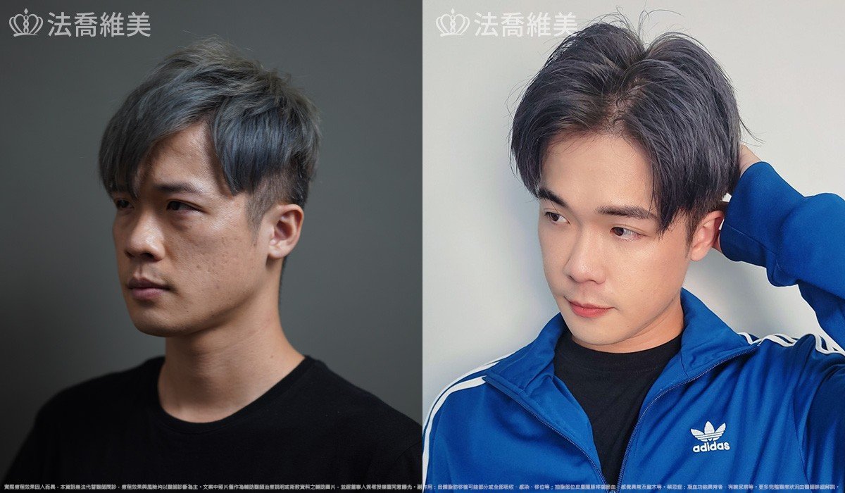 自體脂肪豐蘋果肌 / 術前與術後3個月