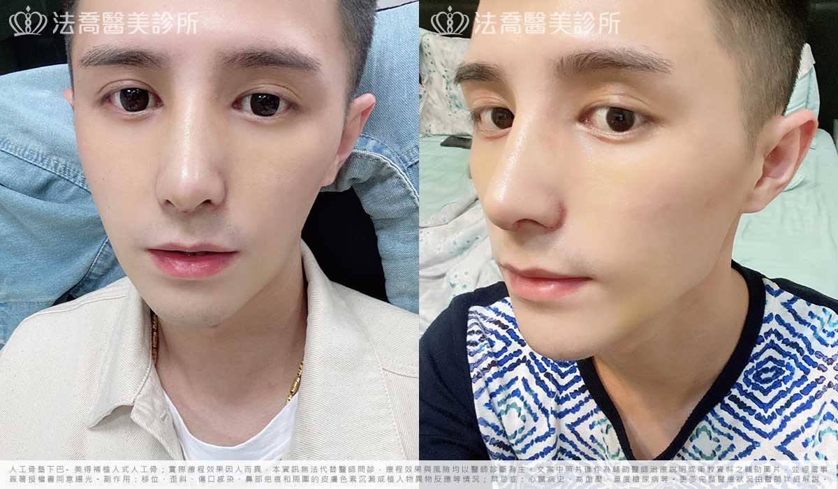 自體肋骨隆鼻,法喬醫美診所,邱浚彥