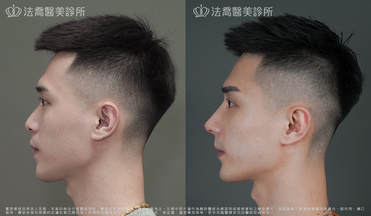 法喬醫美診所,邱浚彥,自體肋骨隆鼻,隆鼻推薦
