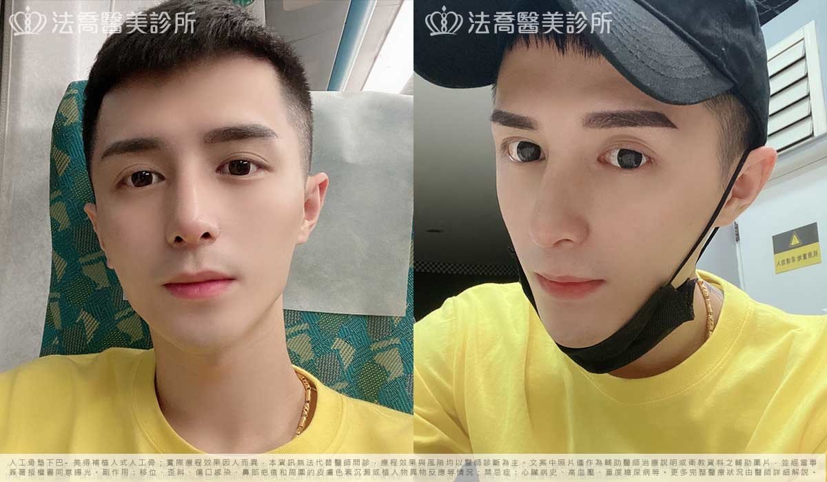 自體肋骨隆鼻,法喬醫美診所,邱浚彥