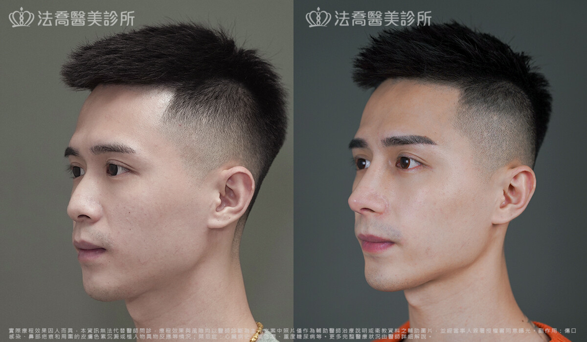 法喬醫美診所,邱浚彥,自體肋骨隆鼻,隆鼻推薦