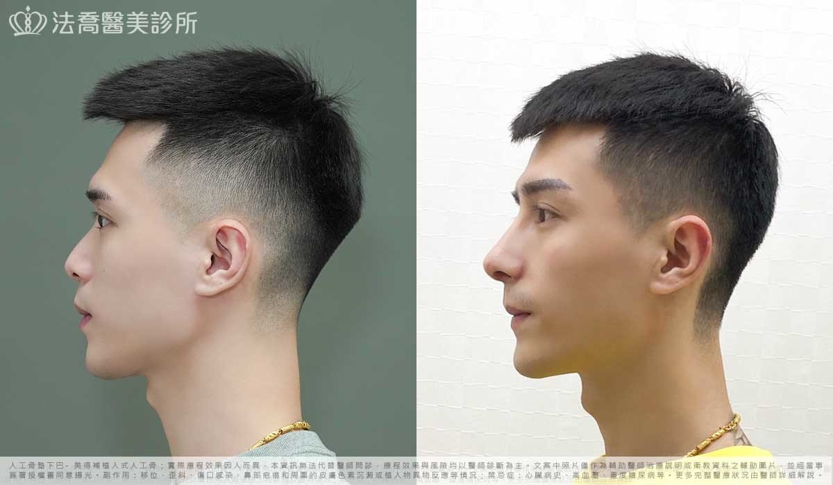 自體肋骨隆鼻,法喬醫美診所,邱浚彥