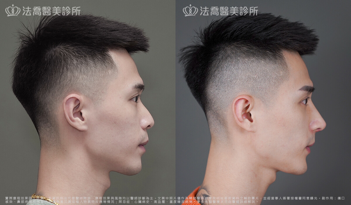 法喬醫美診所,邱浚彥,自體肋骨隆鼻,隆鼻推薦