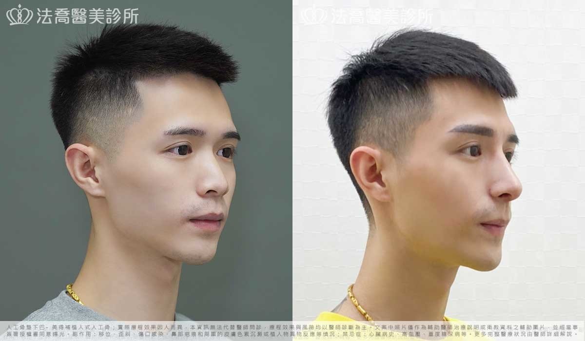 自體肋骨隆鼻,法喬醫美診所,邱浚彥