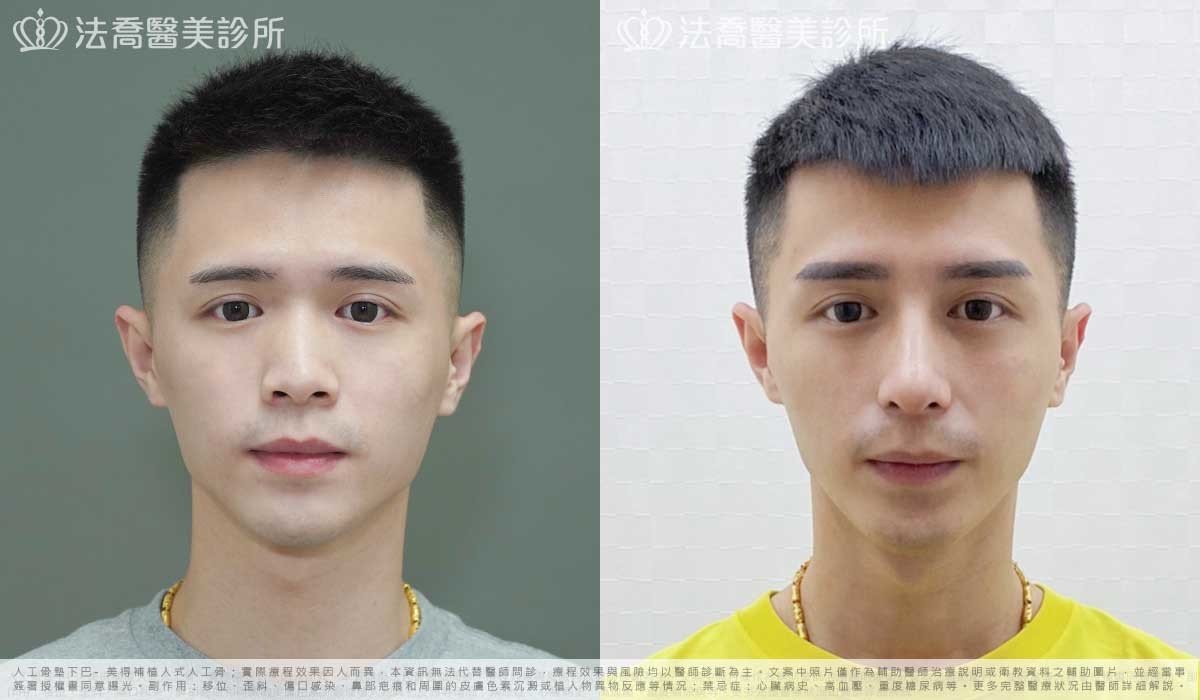 法喬醫美診所,邱浚彥,自體肋骨隆鼻,隆鼻推薦