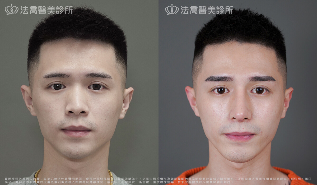 法喬醫美診所,邱浚彥,自體肋骨隆鼻,隆鼻推薦