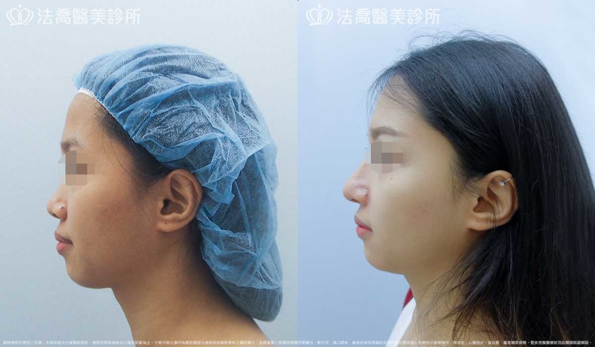 法喬醫美診所,邱浚彥,自體肋骨隆鼻