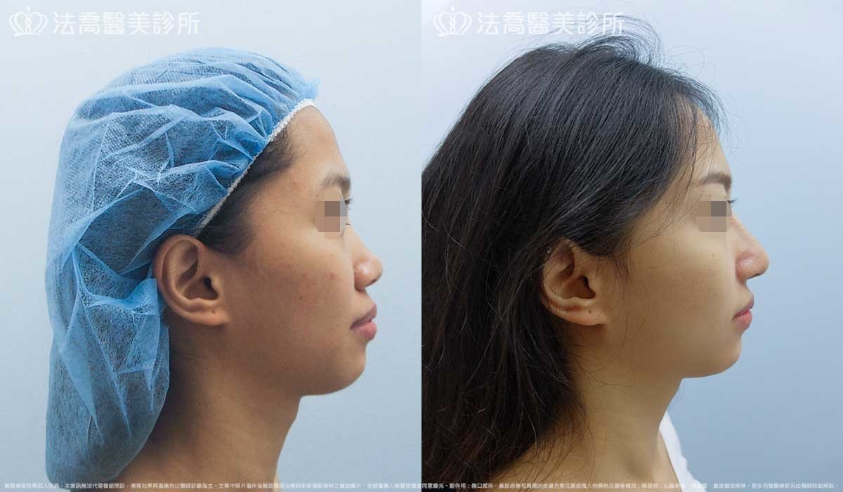 法喬醫美診所,邱浚彥,自體肋骨隆鼻