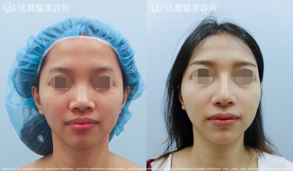 法喬醫美診所,邱浚彥,自體肋骨隆鼻