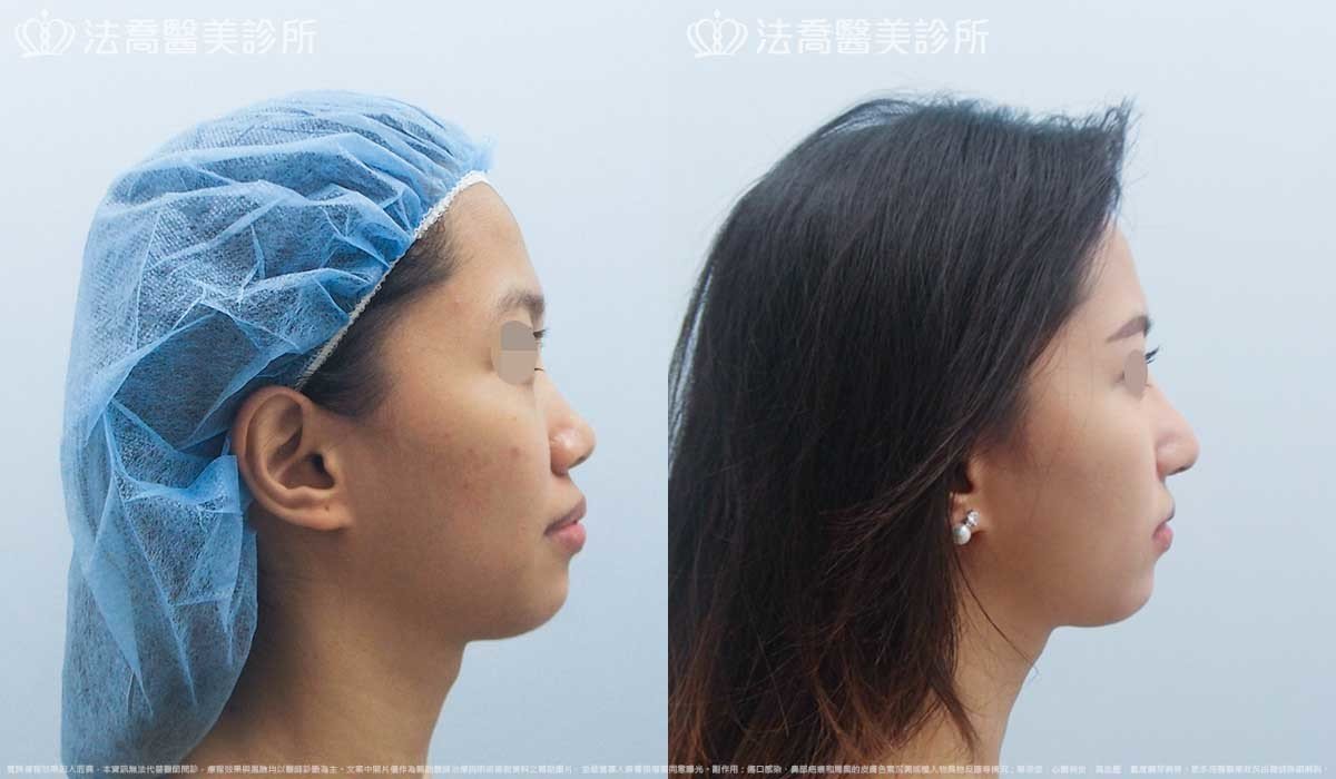 法喬醫美診所,邱浚彥,自體肋骨隆鼻