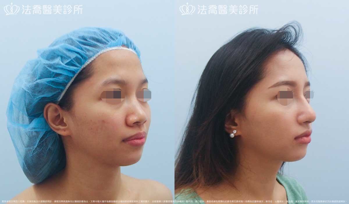 法喬醫美診所,邱浚彥,自體肋骨隆鼻