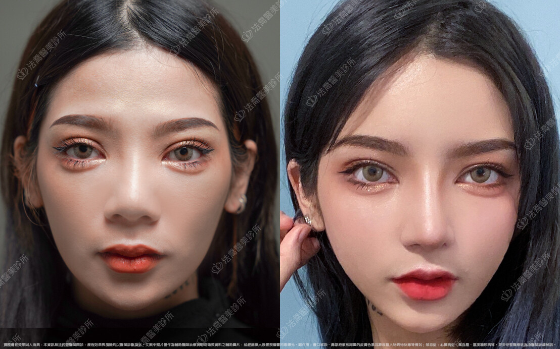 自體脂肪豐臉