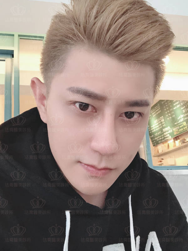 肋骨隆鼻