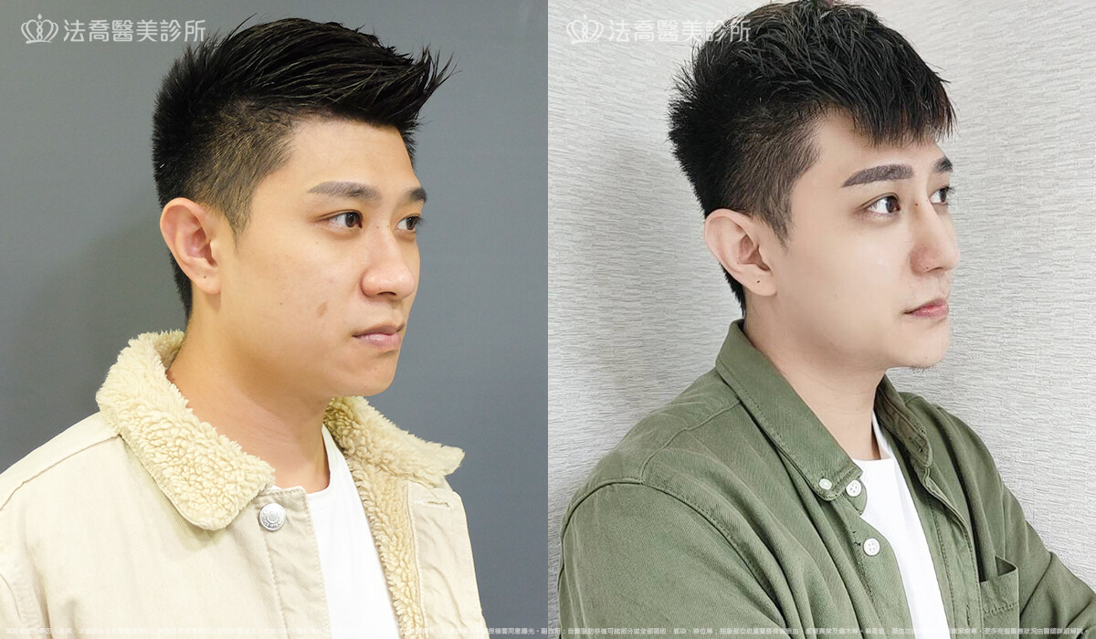 法喬醫美診所,邱浚彥,自體肋骨隆鼻