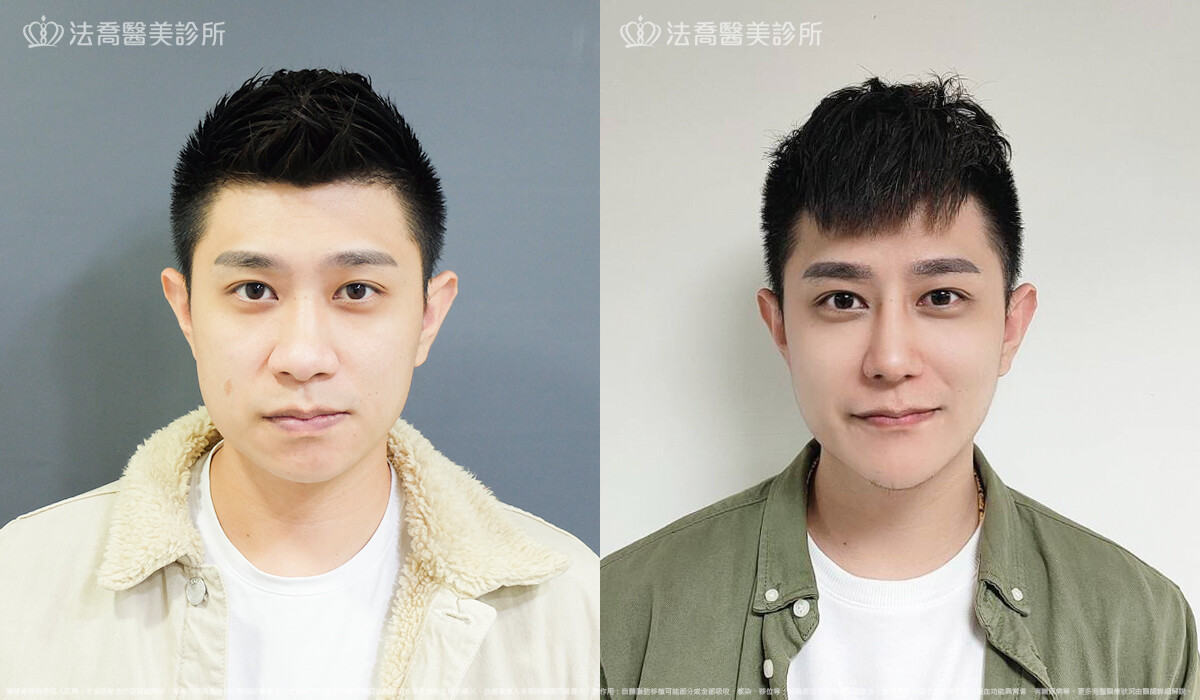 法喬醫美診所,邱浚彥,自體肋骨隆鼻