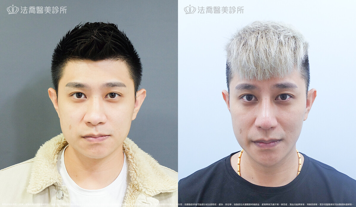 法喬醫美診所,邱浚彥,自體肋骨隆鼻