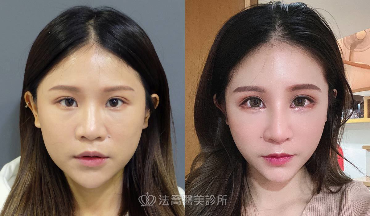 自體肋骨隆鼻