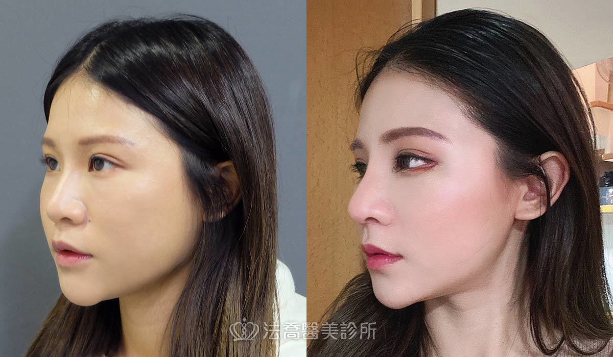 自體肋骨隆鼻