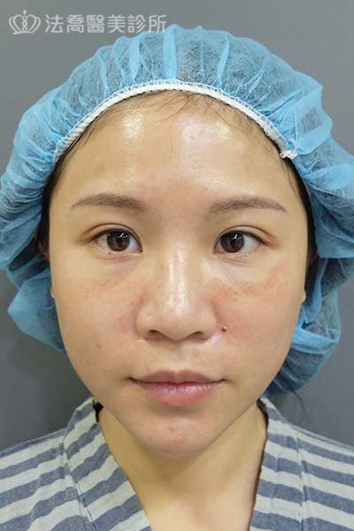 法喬醫美診所 邱浚彥醫師 自體肋骨隆鼻