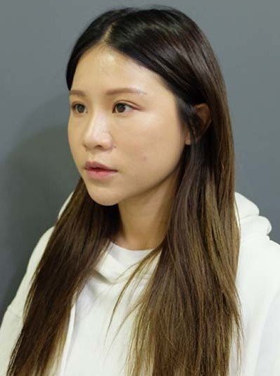自體肋骨隆鼻