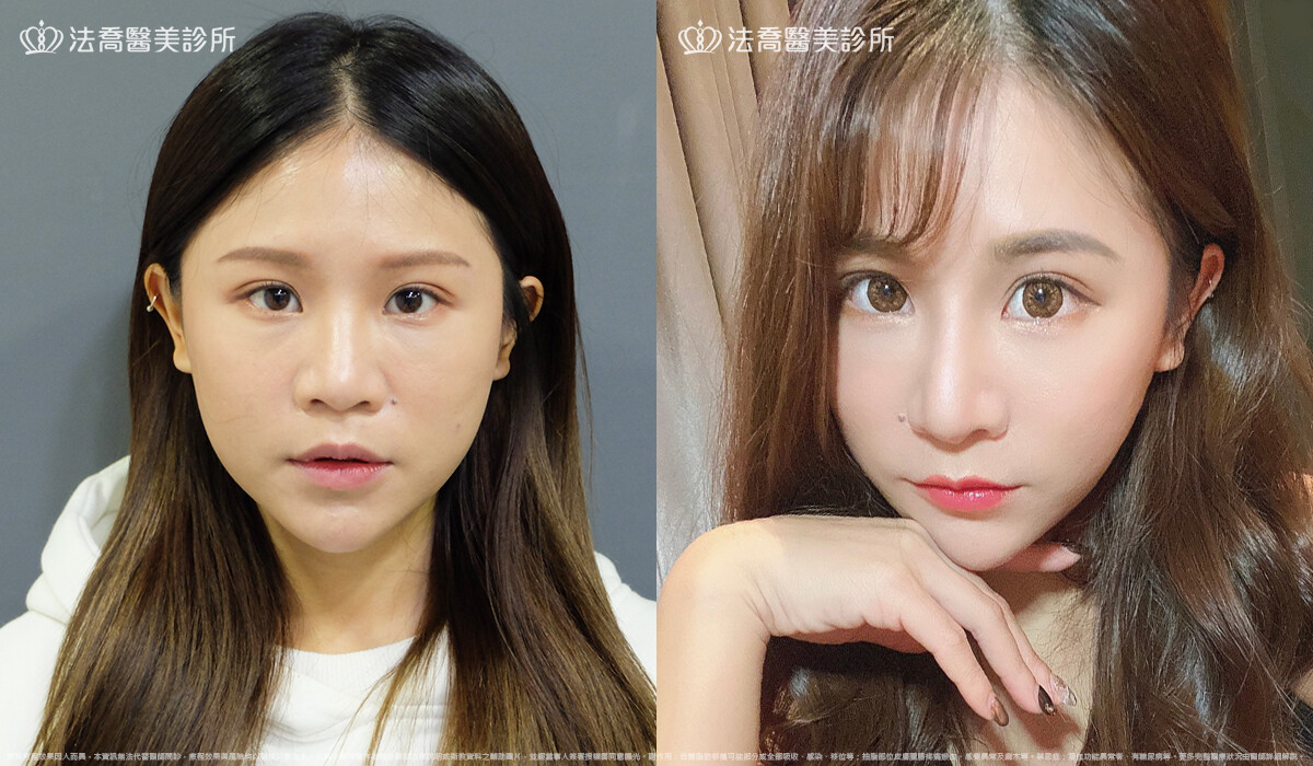 法喬醫美診所,邱浚彥,自體肋骨隆鼻