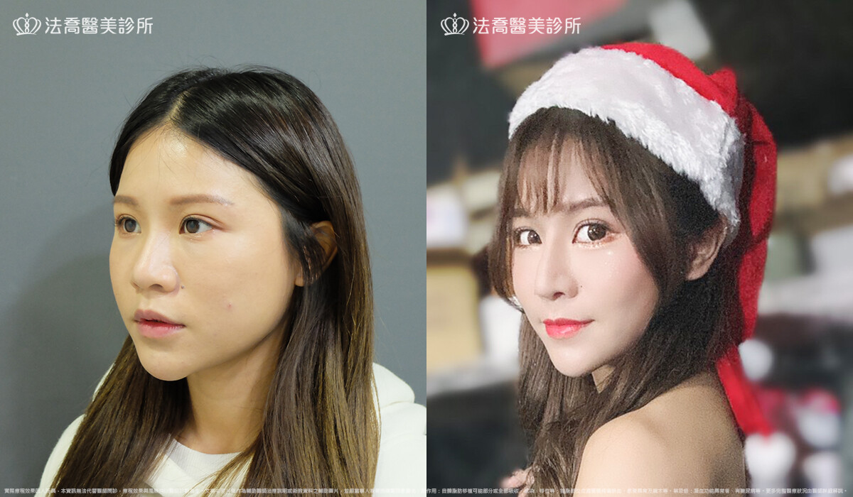 法喬醫美診所,邱浚彥,自體肋骨隆鼻