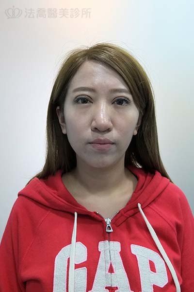自體肋骨隆鼻