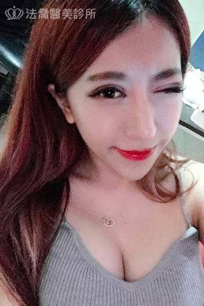 自體肋骨隆鼻