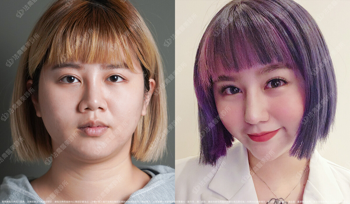 混血感美鼻 自體肋骨隆鼻 縮鼻翼 3個月 術前與術後