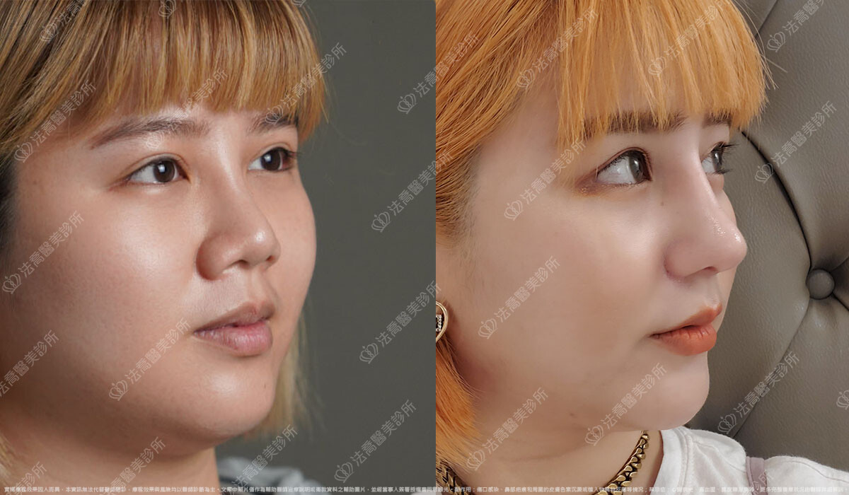 混血感美鼻 自體肋骨隆鼻 縮鼻翼 1個月 術前與術後
