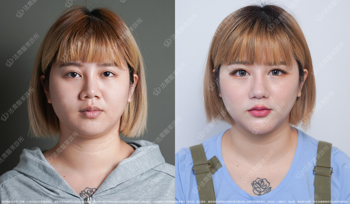 混血感美鼻 自體肋骨隆鼻 縮鼻翼 5個月 術前與術後