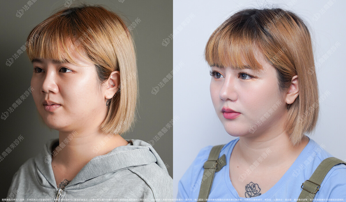 混血感美鼻 自體肋骨隆鼻 縮鼻翼 5個月 術前與術後