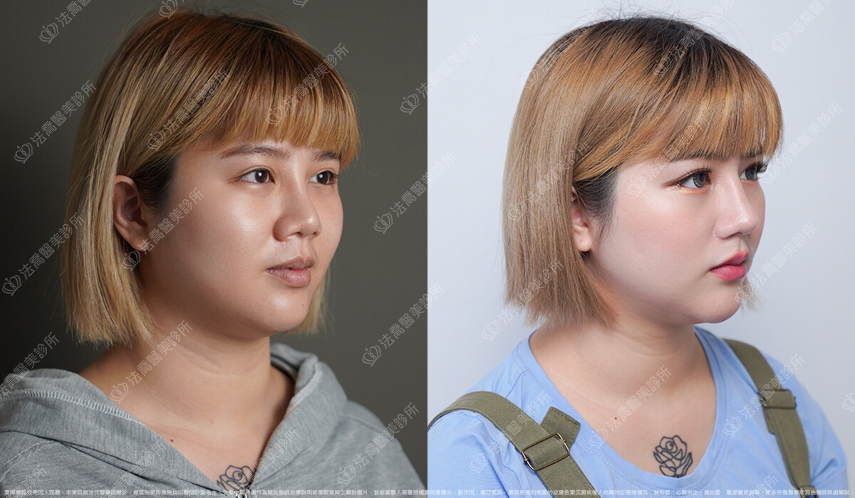 混血感美鼻 自體肋骨隆鼻 縮鼻翼 5個月 術前與術後