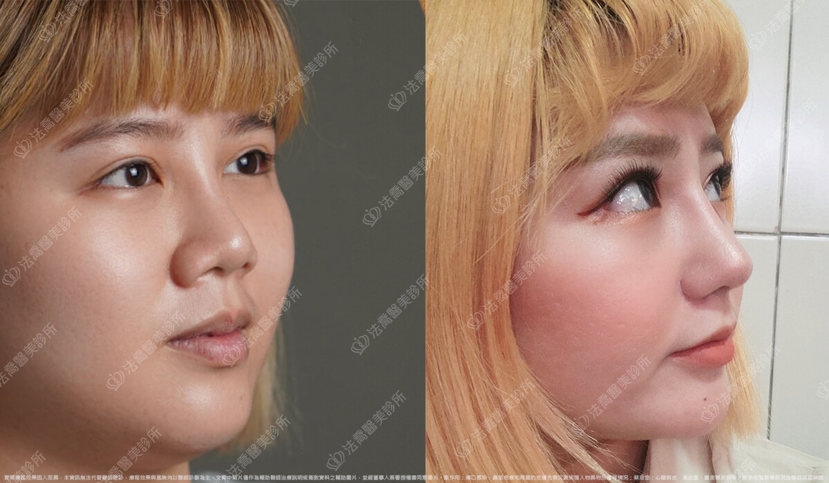 混血感美鼻 自體肋骨隆鼻 縮鼻翼 3個月 術前與術後