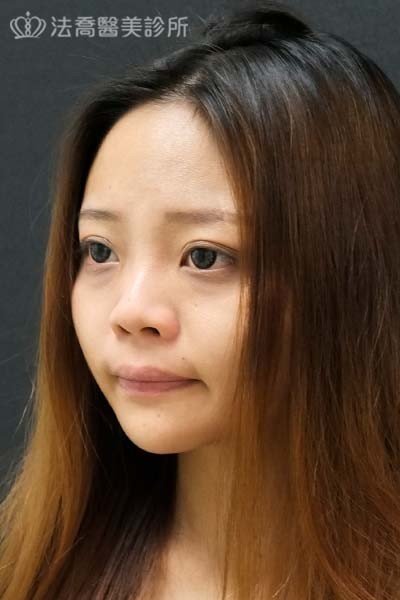 法喬醫美診所自體肋骨隆鼻術後15天BA圖