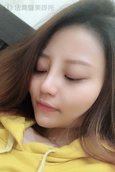 法喬醫美診所自體肋骨隆鼻術後12天