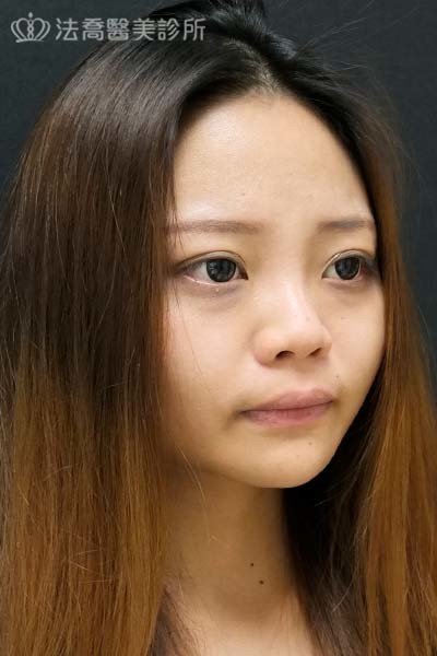 法喬醫美診所自體肋骨隆鼻術前